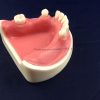 Dental Implant Model with Soft Gingiva for Doctor Practice