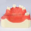 Cheap Resin Dental Implant Model Limited Supply