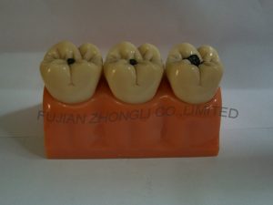 4 Times Size Caries Demonstrating Model