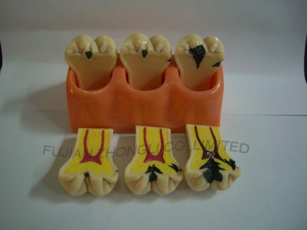 4 Times Size Caries Demonstrating Model