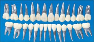 Permanent Teeth Metal Root Resin Crown for Orthodontic Models