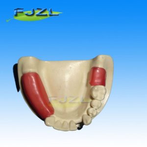 Dental Implant Material Bone Graft Implant Model