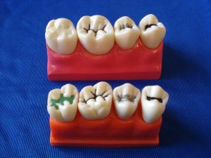 Dental Four Times The Pit and Fissure Model