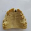 Dental Implant for Doctor Training