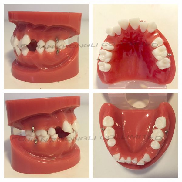Deluxe Dental Orthodontics Typodont Model
