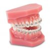 Cheap Orthodontic Demonstrator Model