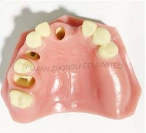 Sinus Lift Dental Implant Zhongli Company