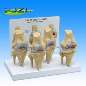 4-Stage Osteo-Arthritic Knee Anatomical Model
